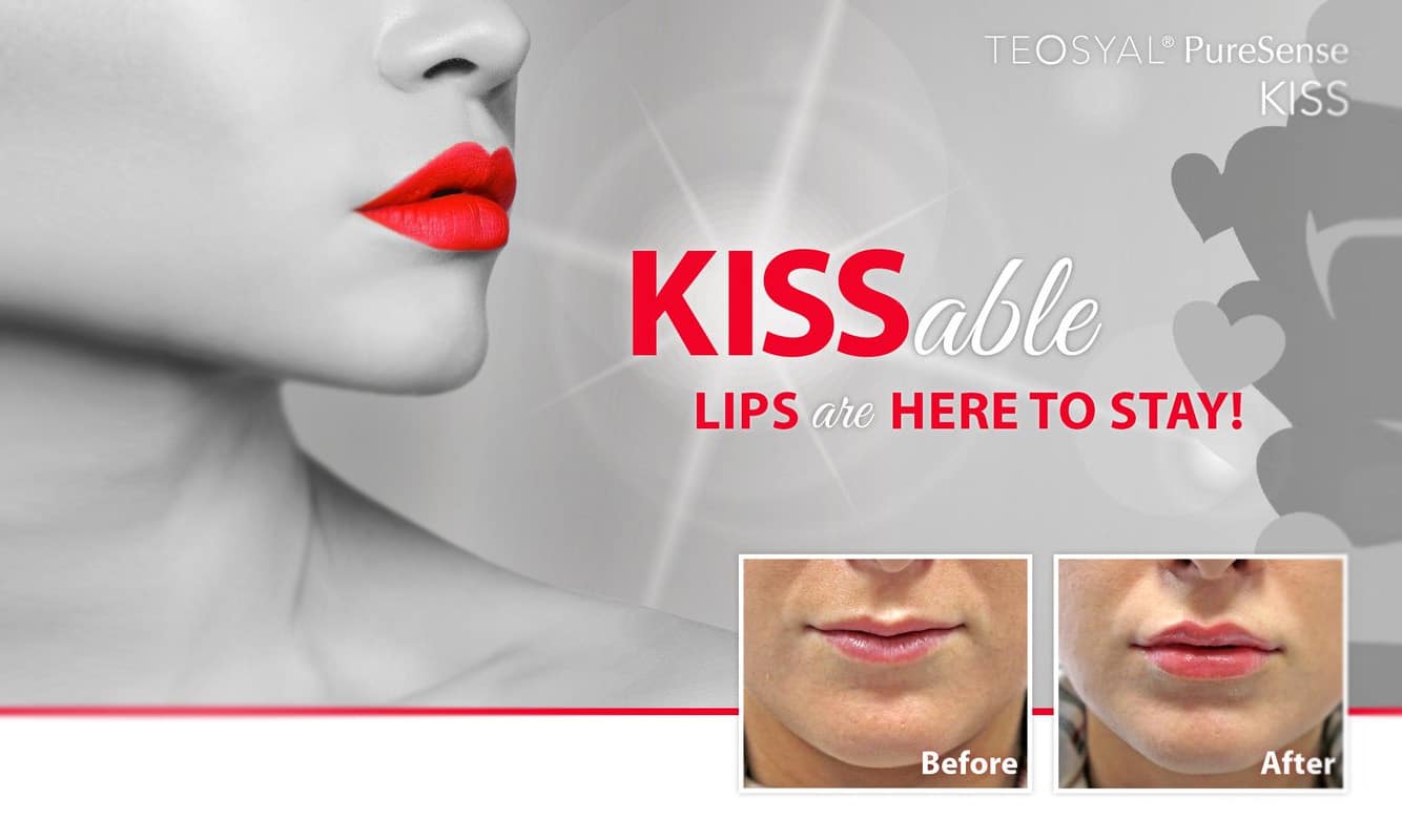 teosyal-puresense-ottawa-kiss - Kanata Plastic and Cosmetic Surgery