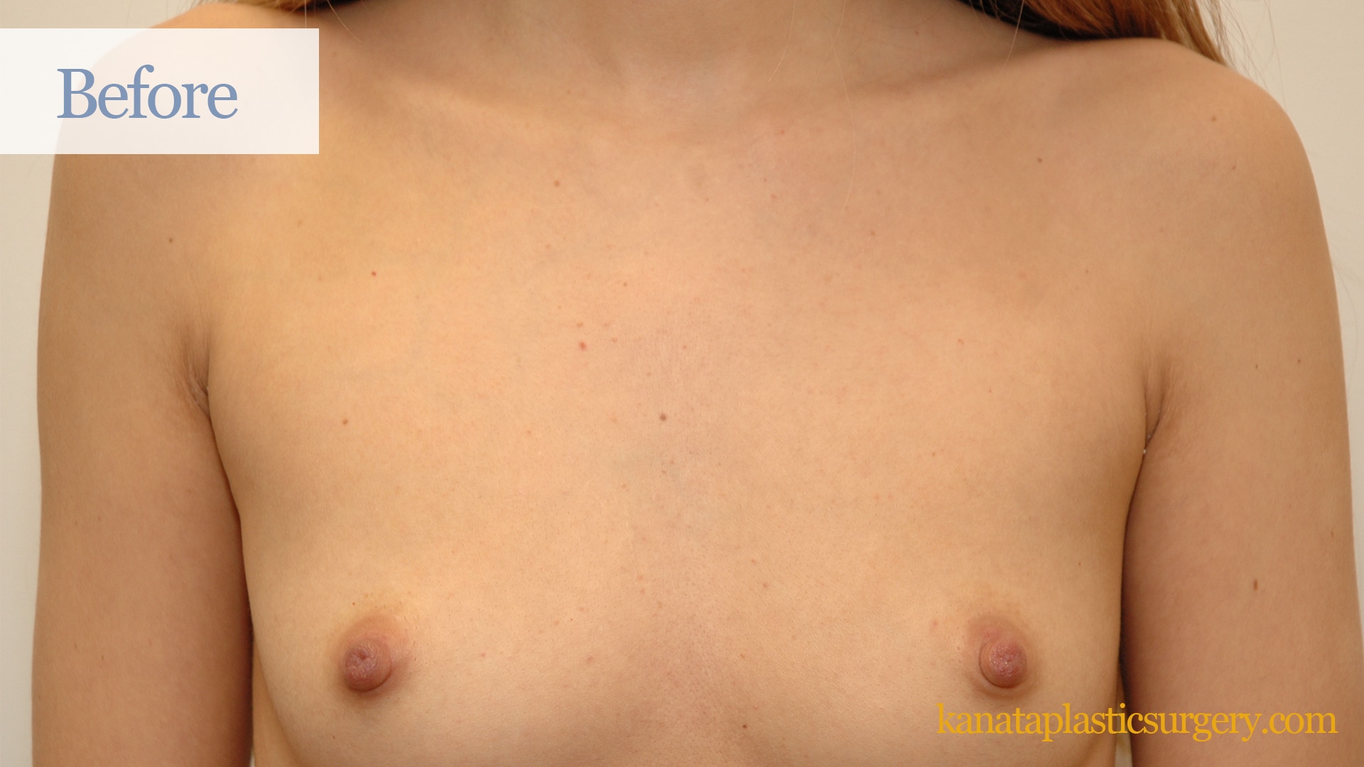 https://www.kanataplasticsurgery.com/wp-content/uploads/2023/09/breast-augmentation-ottawa-boob-job-cosmetic-kanata-before-plastic-surgery-sergical-34.jpg