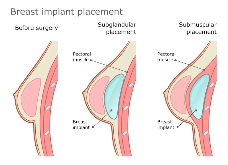 vector image showing breast implant placements