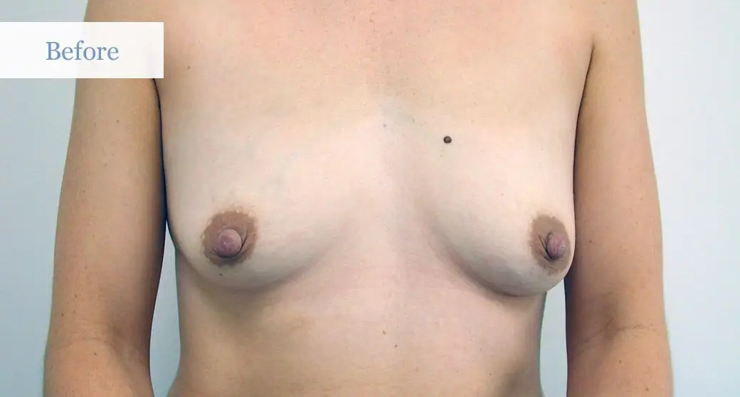 Ottawa Breast Lift Before and After 3