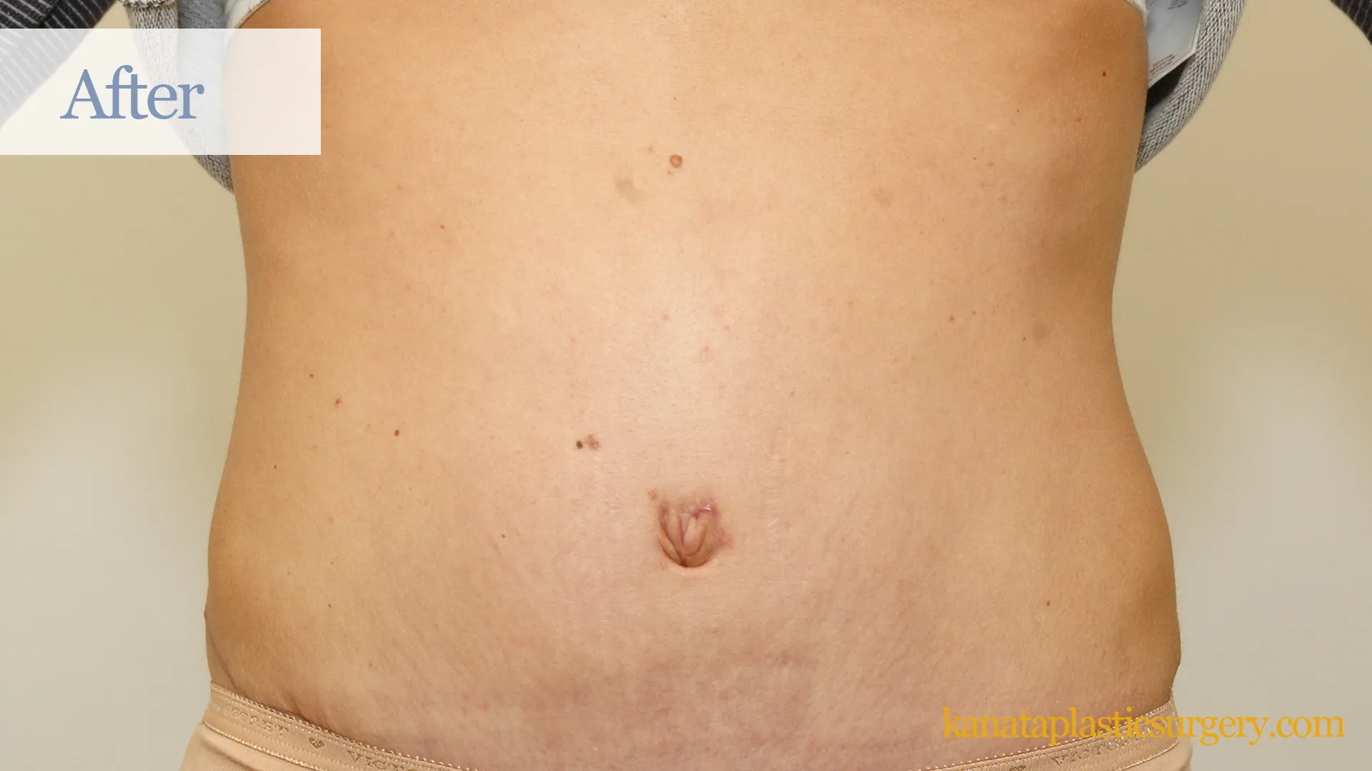 abdominoplasty ottawa tummy tuck cosmetic kanata plastic surgery sergical after 38