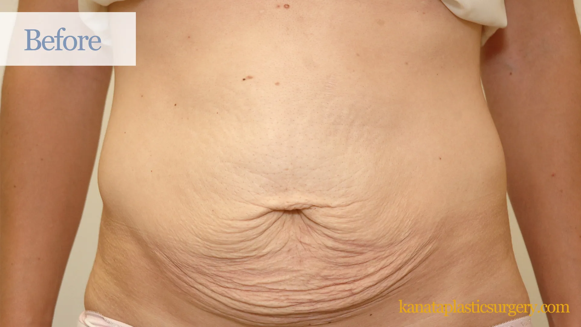 abdominoplasty ottawa tummy tuck cosmetic kanata plastic surgery sergical before 38