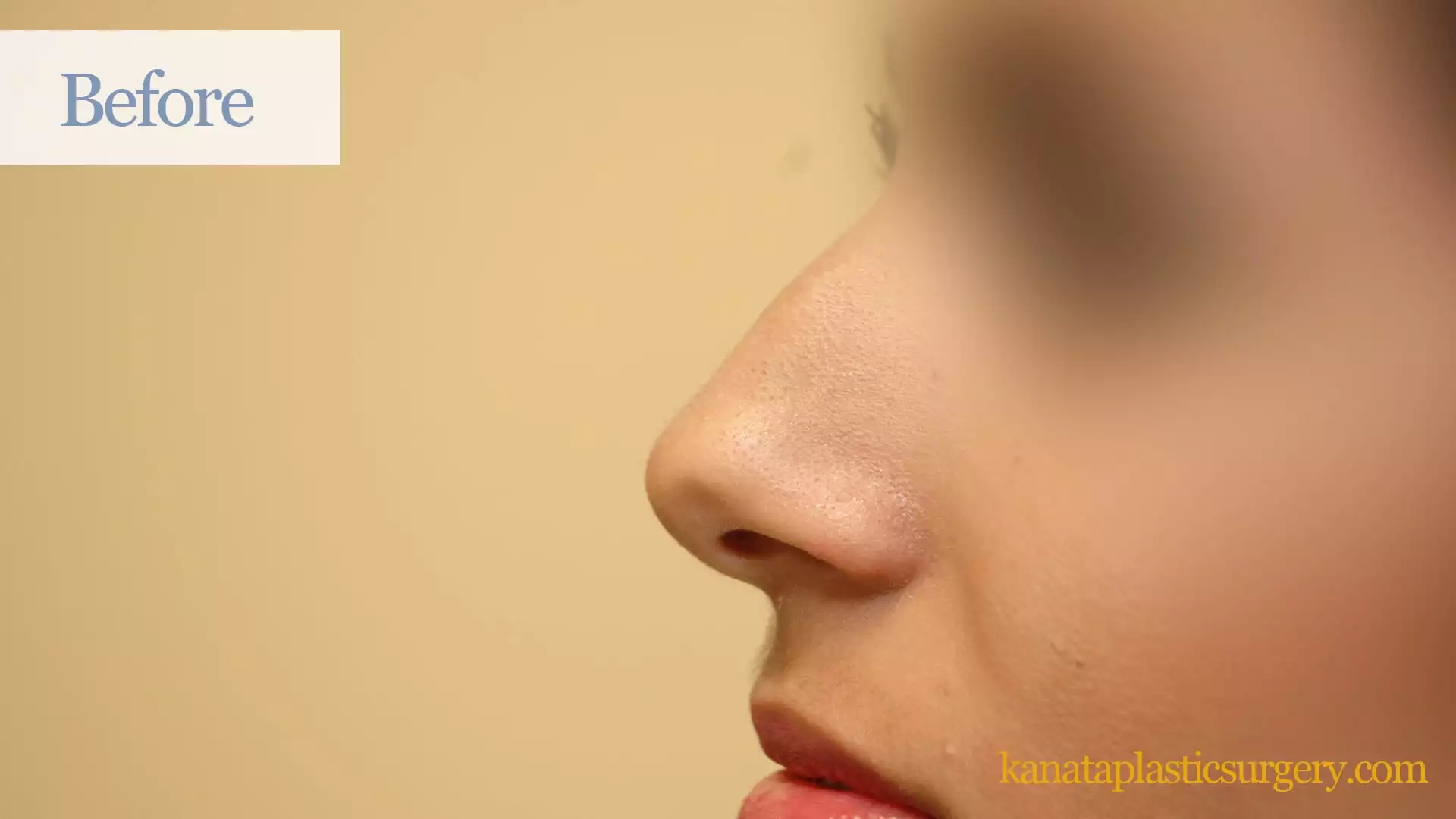 before rhinoplasty fall 2019 16 kanata plastic surgery ottawa nose job cosmetic surgical